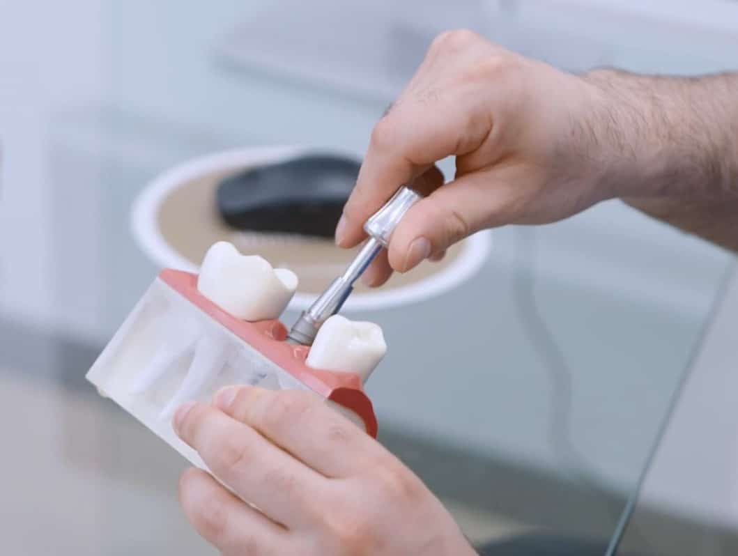 Implante dental post extracción