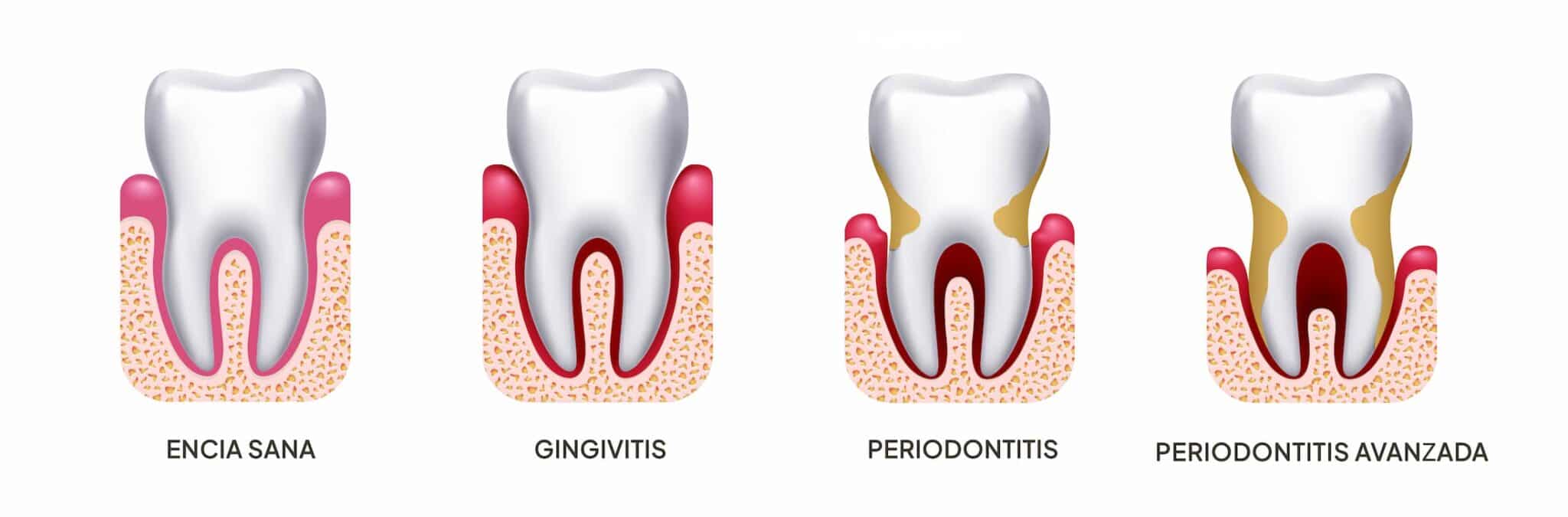 Tipos de enfermedades de encías