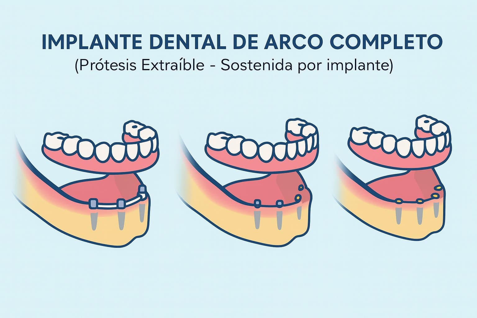 Implante dental extraible