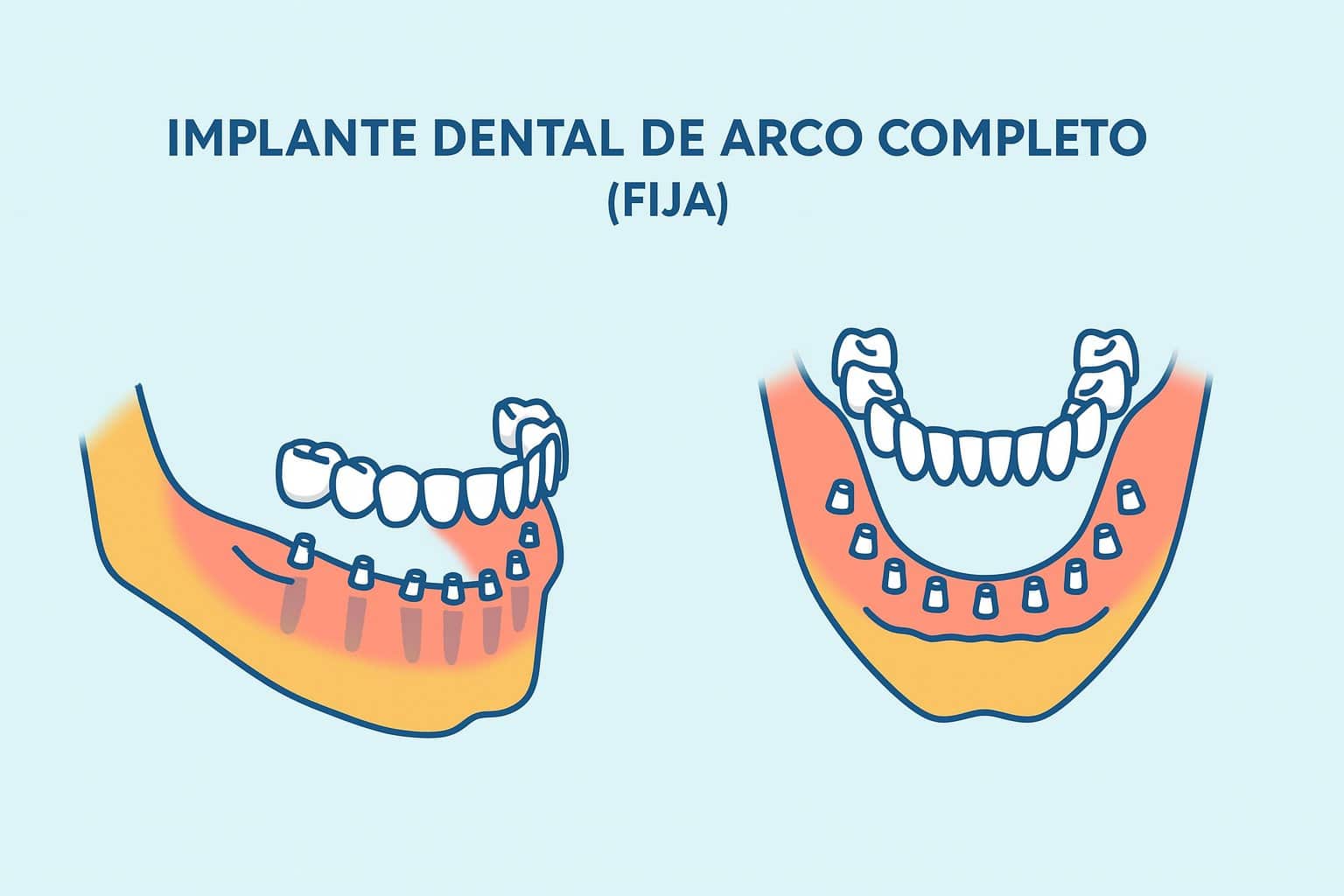 Implante dental de arca completa