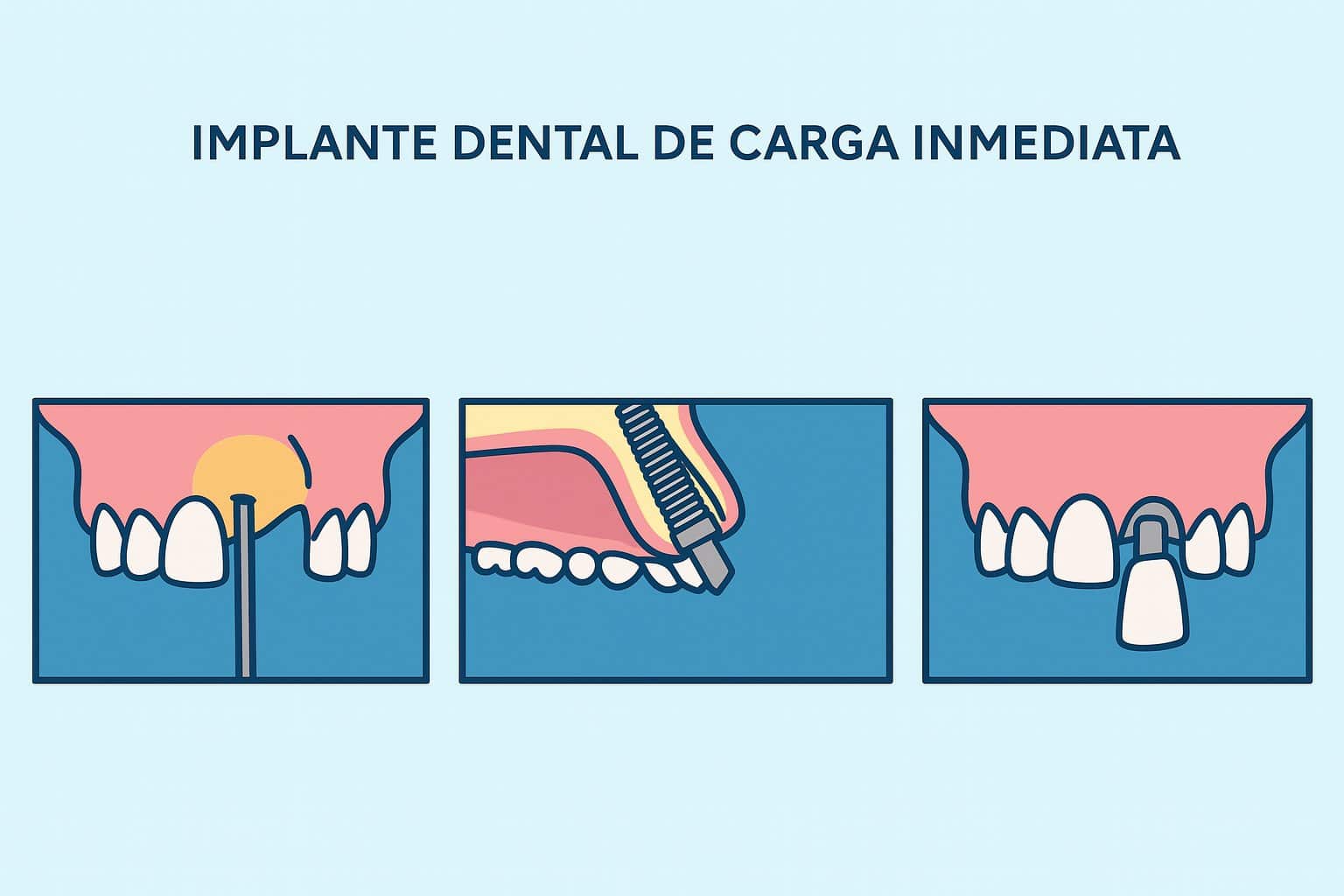 Implante dental carga inmediata