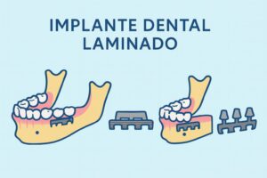 Implante dental laminado