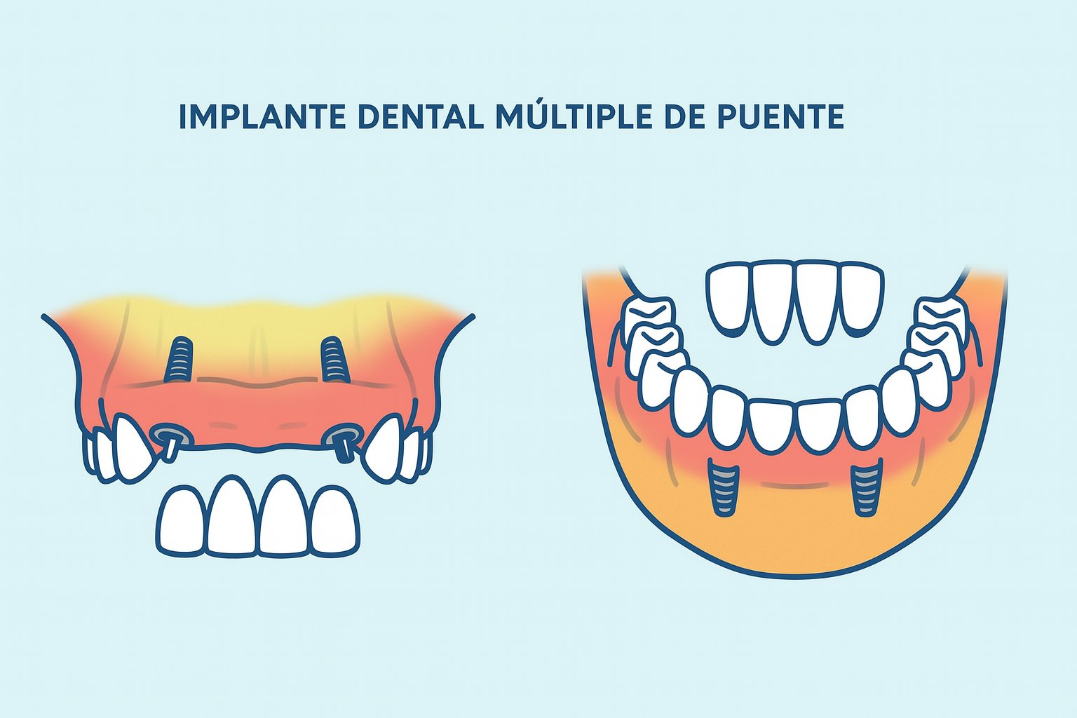 Implante dental múltiple