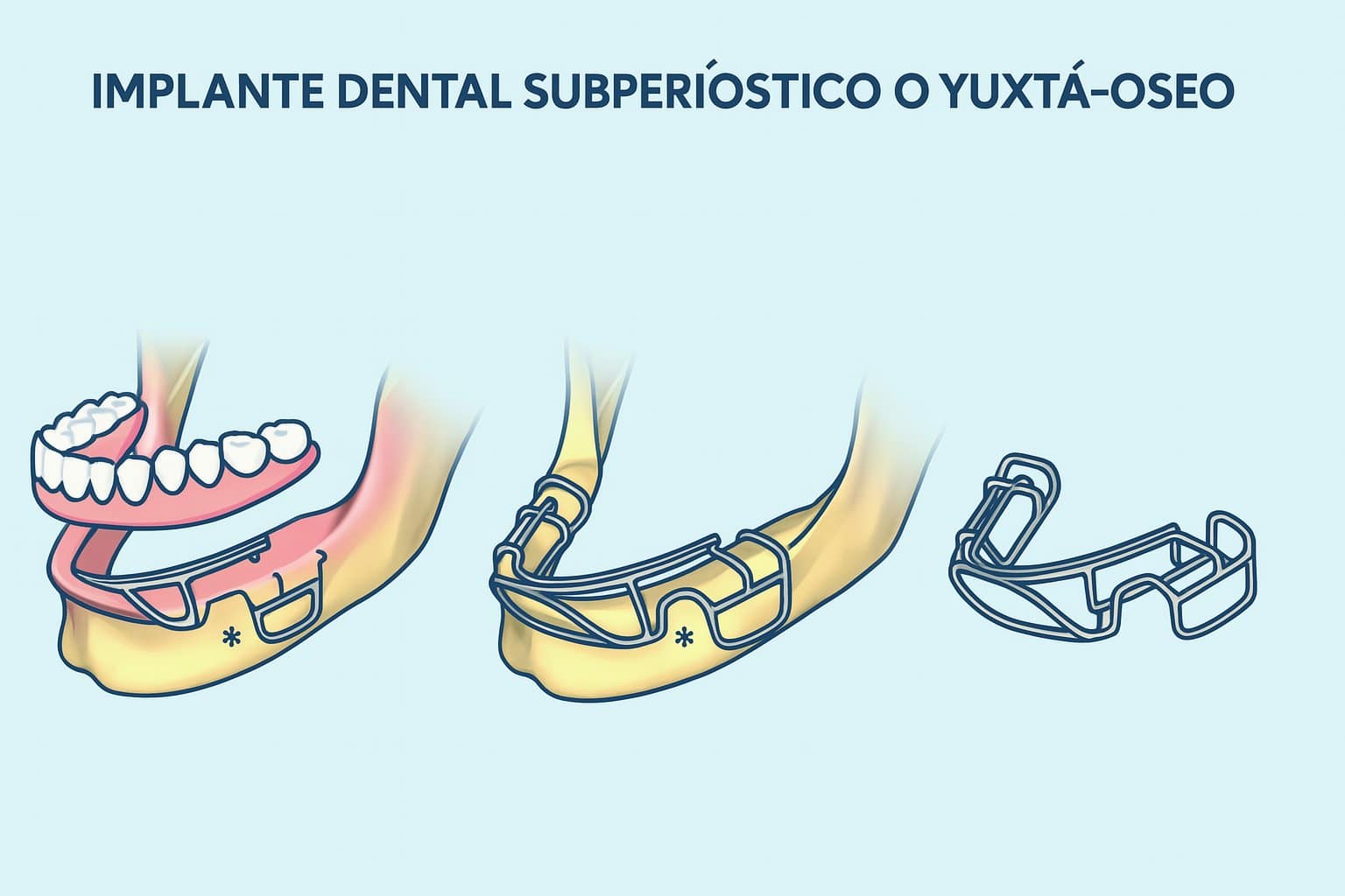 Implante dental subperiostático