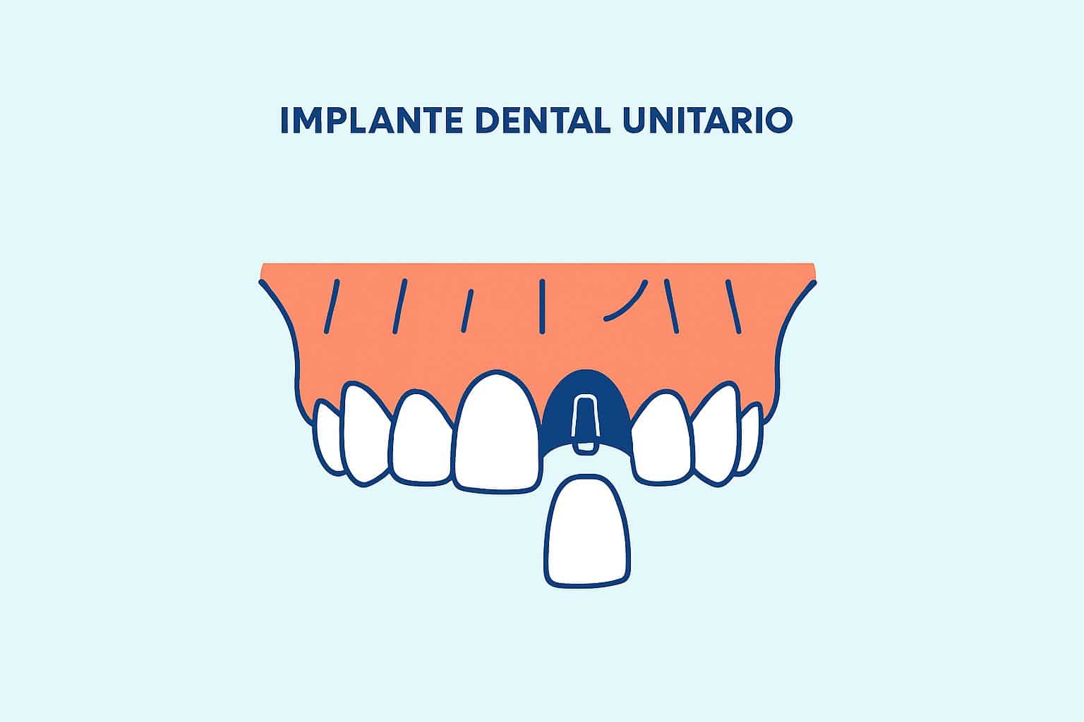 Implante dental unitario