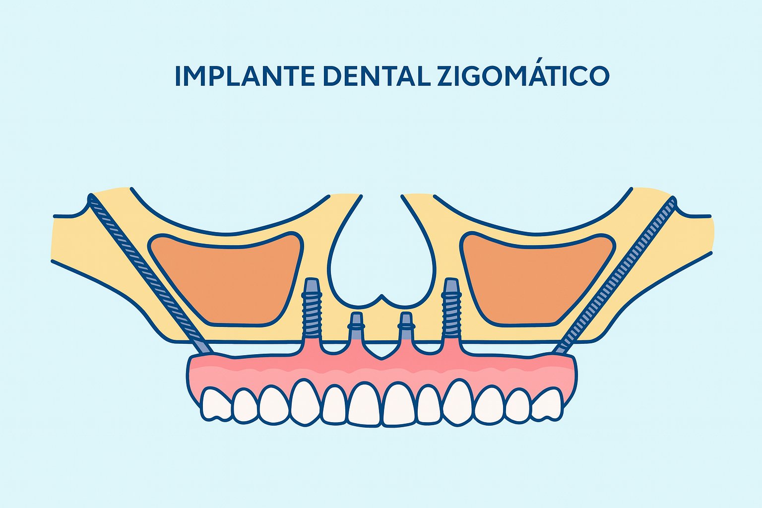Implante dental Zigomático