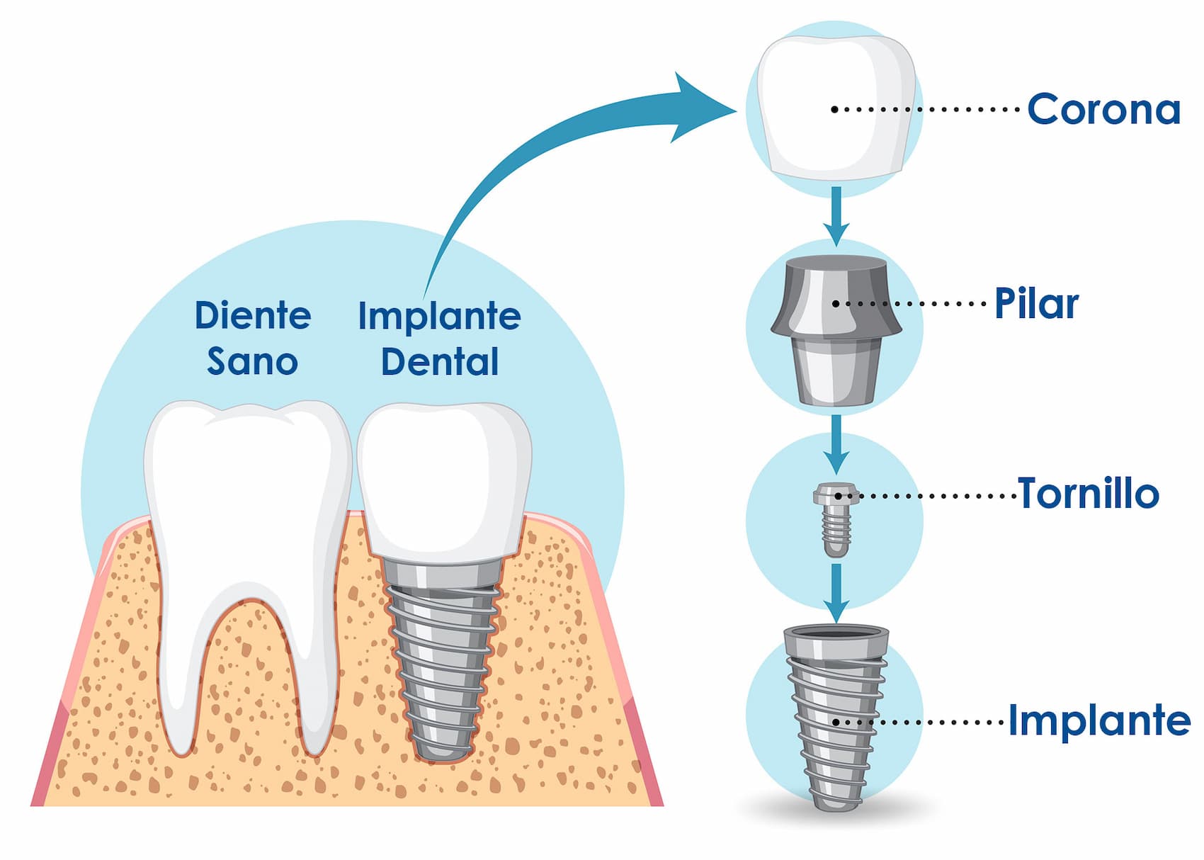 Partes de un implante dental